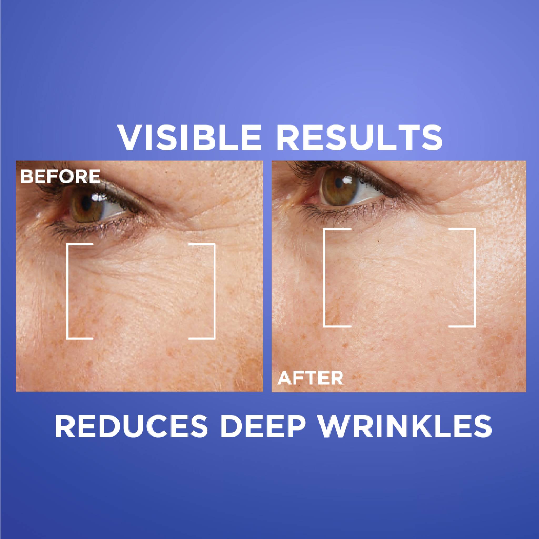 Revitalift Retinol Night Serum For Face, With 0.2% Pure Retinol, Moisturizes Skin and Eliminates Deep Wrinkles, For All Skin Types