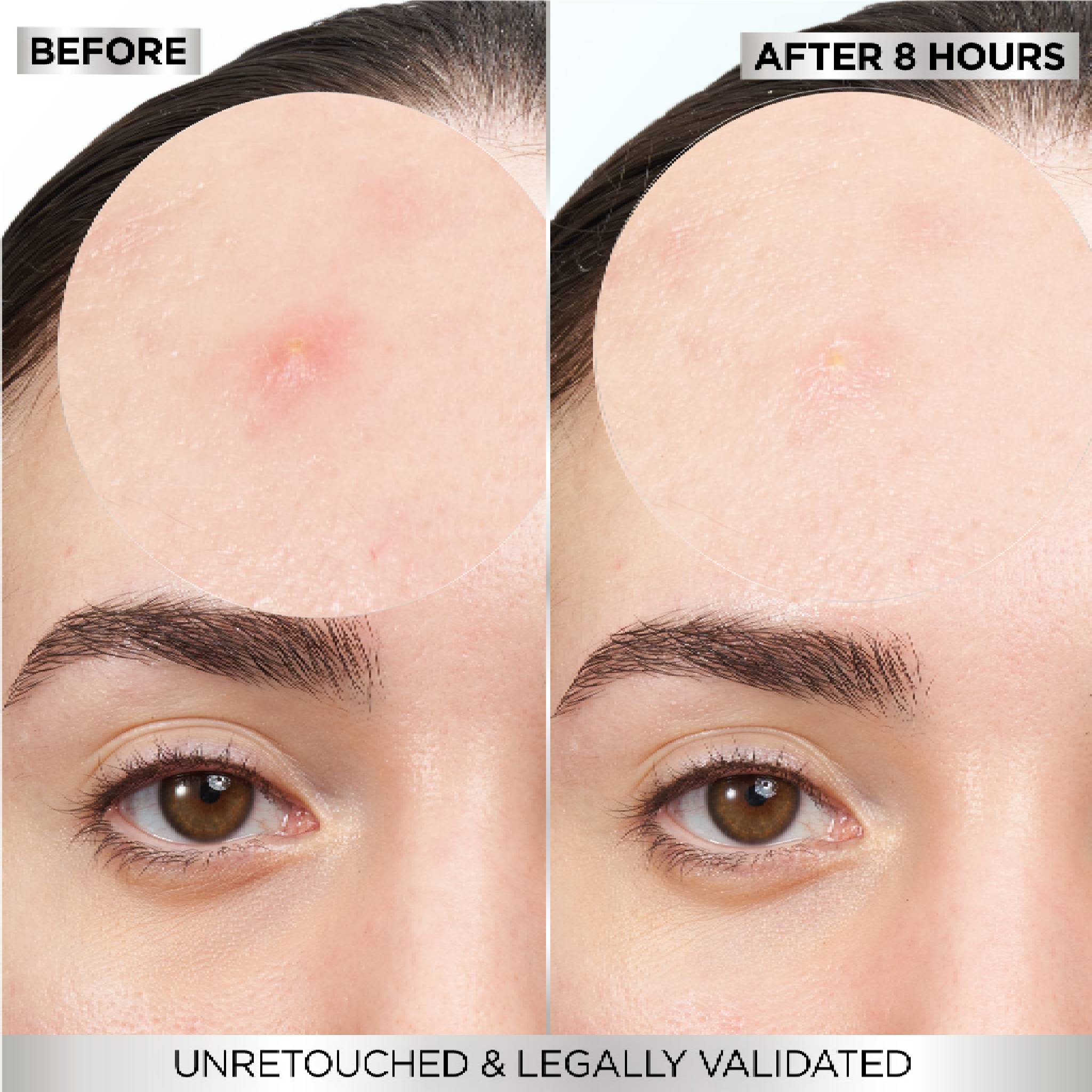 Skin Active Fast Clear Invisible Pimple Patch 8 Hours Hydrocolloid